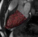 LV endocardial surface from simulations superimposed CMR images from a healthy volunteer study